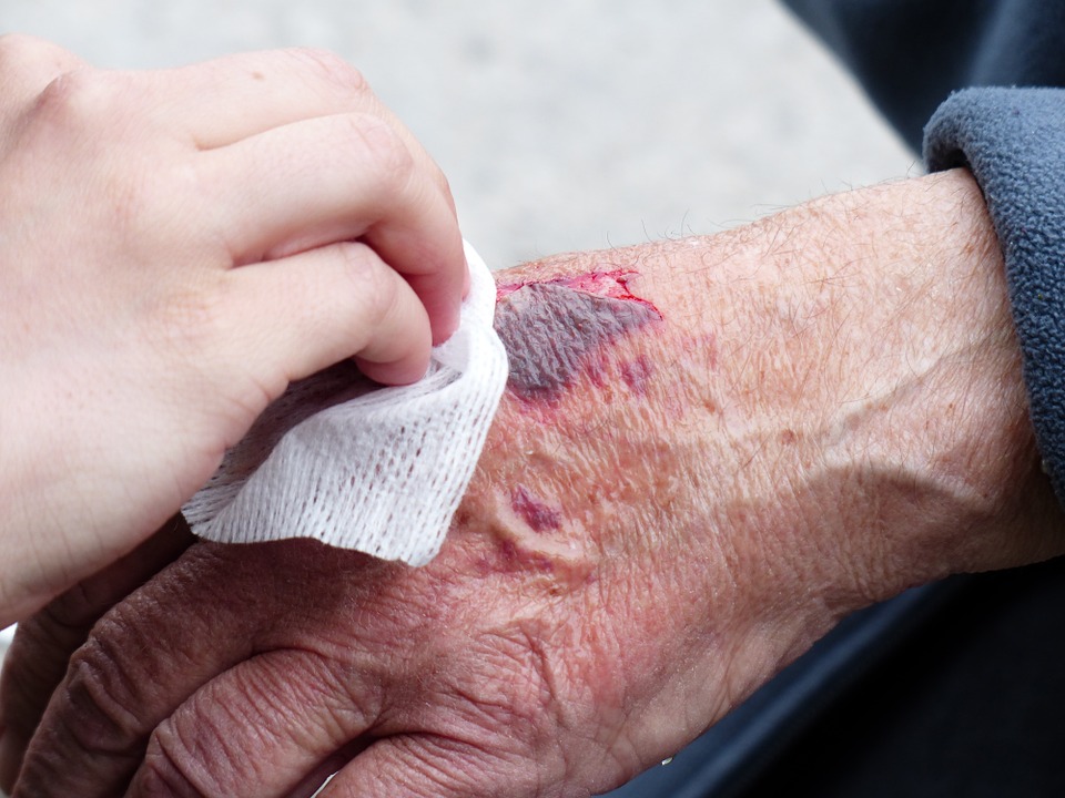 Рана на руке пожилого человека
